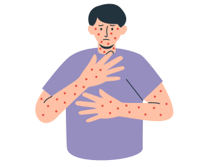 Monkeypox